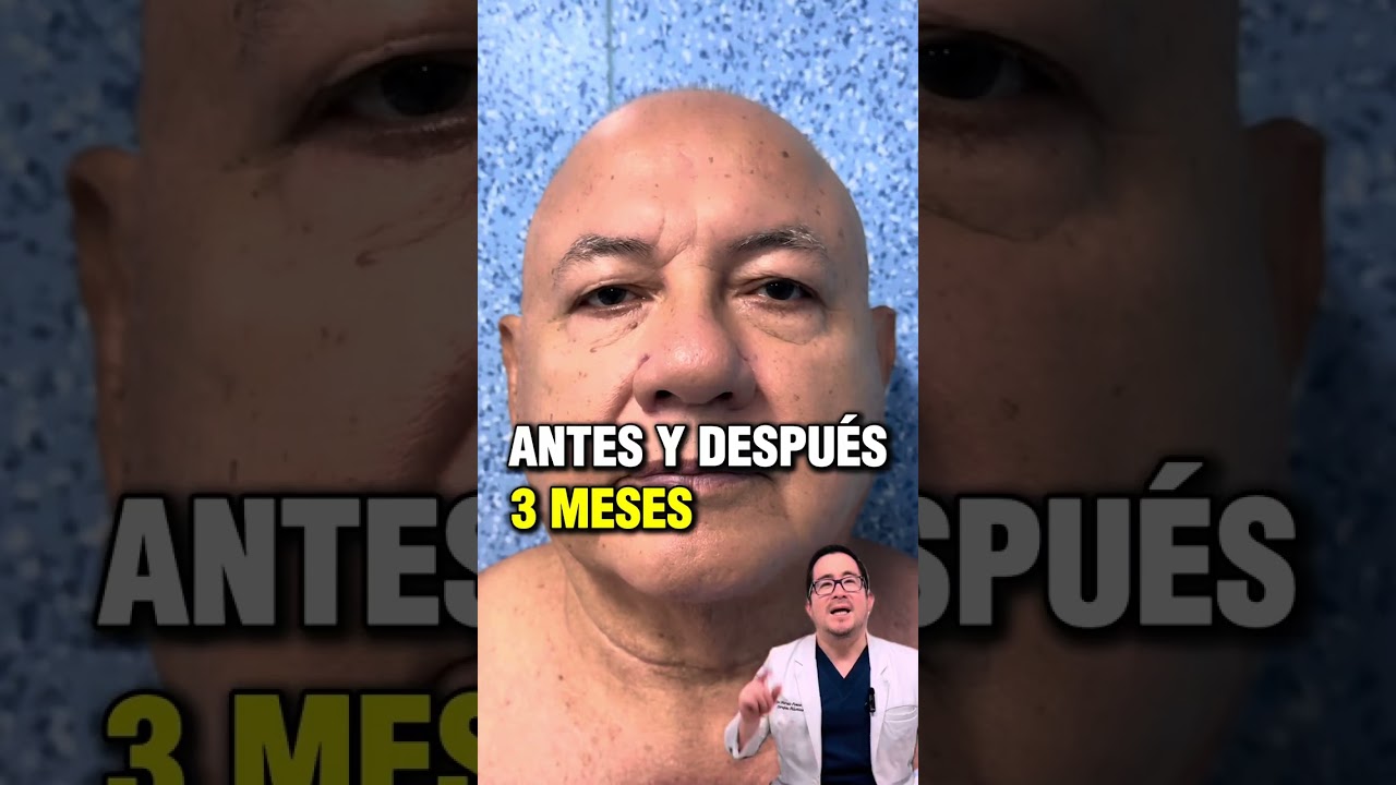 Antes y Después de 3 Meses de Lifting Tercio Superior
