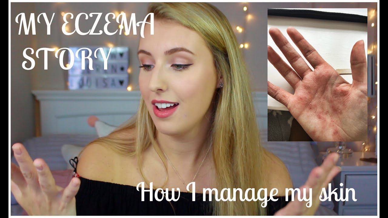 My Eczema Story | How I deal with Pompholyx Eczema