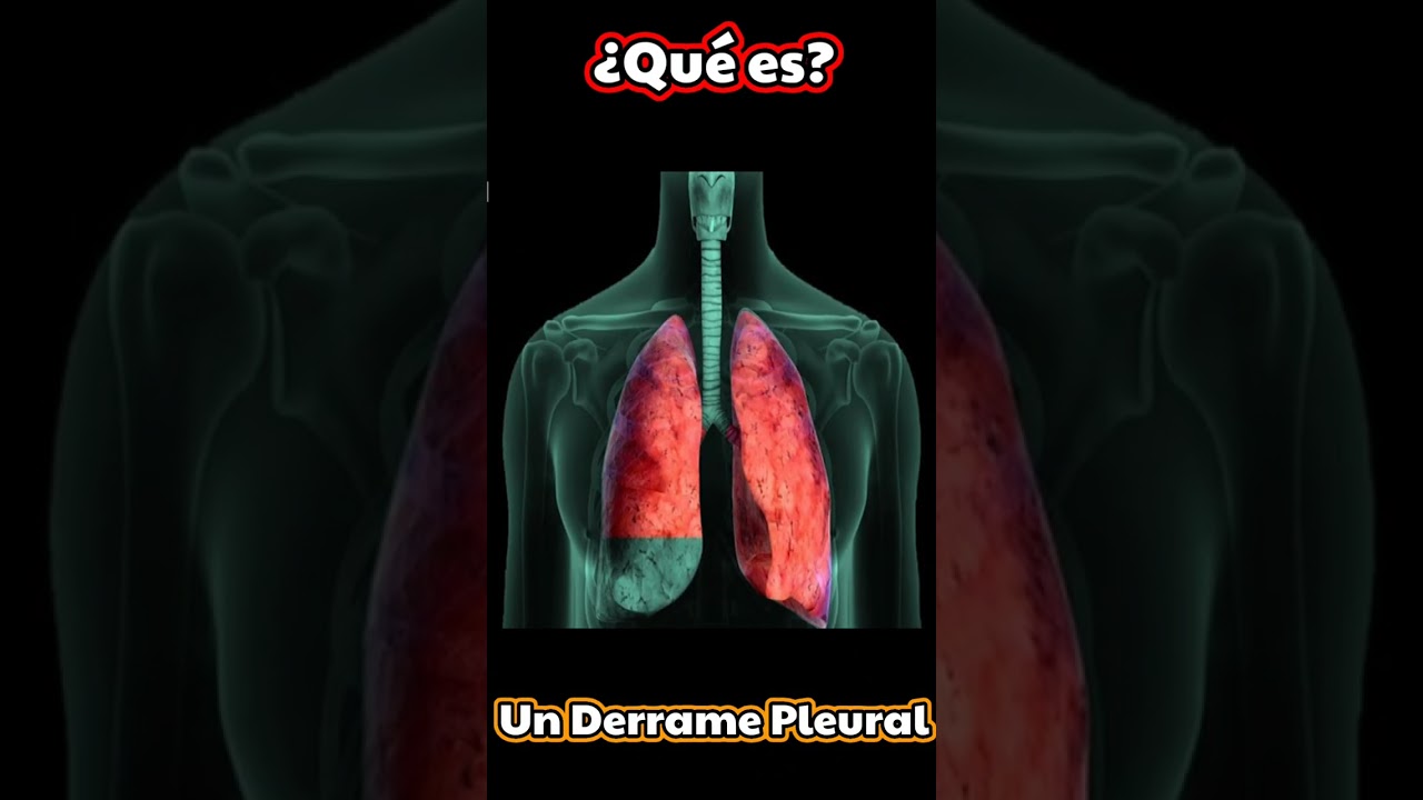 &iquest;QUE ES UN DERRAME PLEURAL? 👍😉 #shorts #medicina