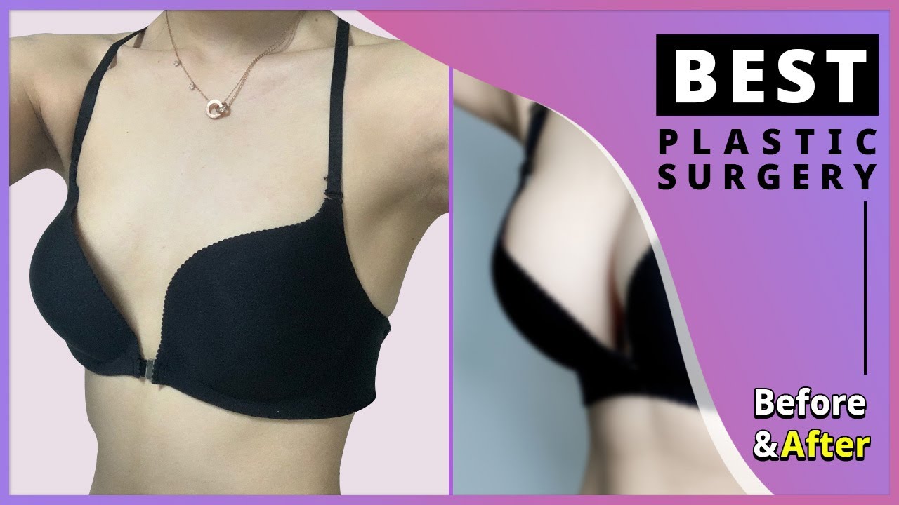 TOP 5 Fantastic Boobjob in Korea Plastic Surgery Hospital | Breast Augmentation Before&After Results
