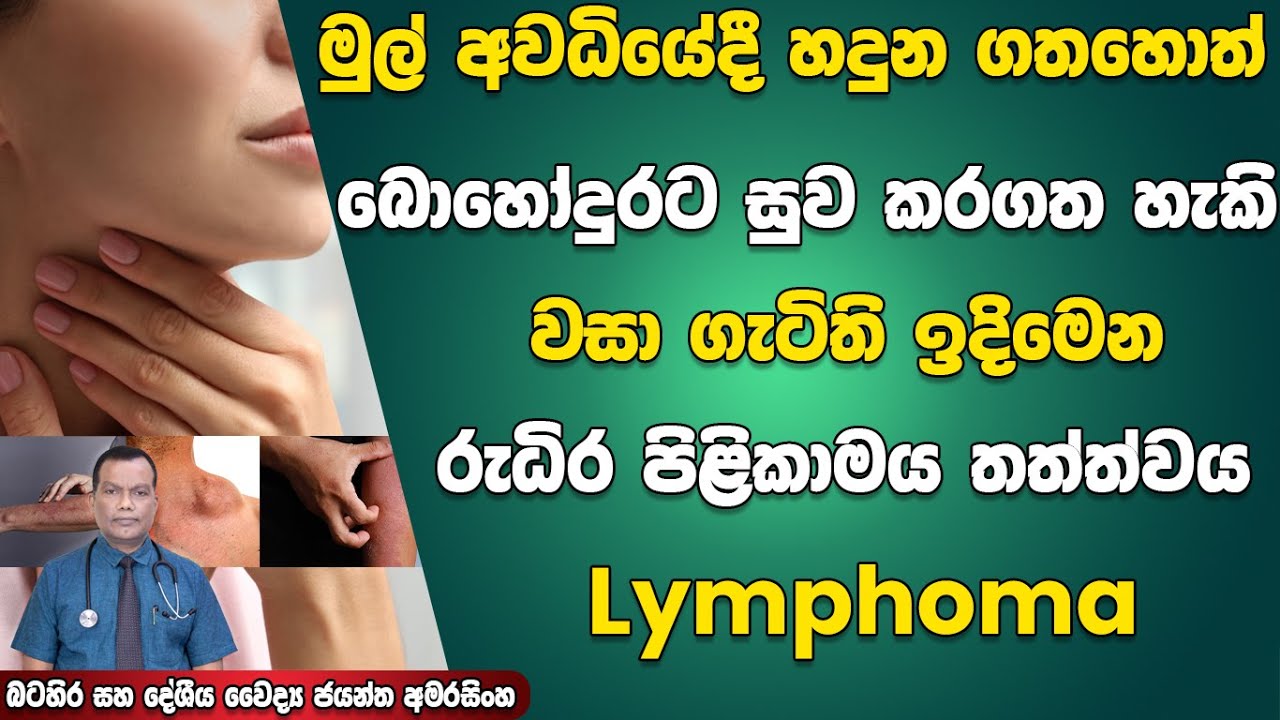 මුල් අවධියේදීම හදුනා ගතහොත් බොහෝ දුරට සුවකරගත හැකි වසා ගැටිති ඉදිමෙන රුධිර පිළිකාමය තත්ත්වය Lymphoma