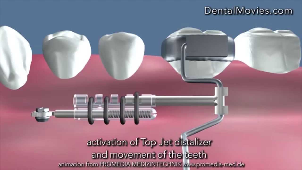 Distalization of the molar using Top Jet Distalizer