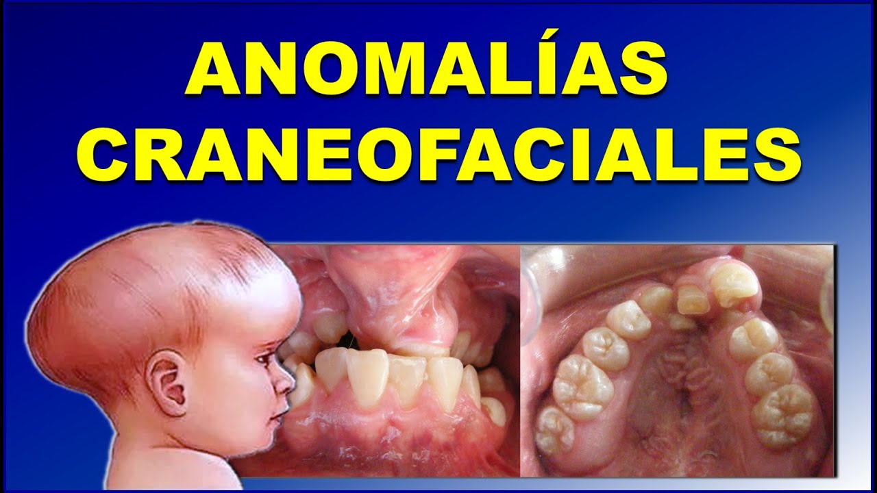 ¿Qué Son las Malformaciones Craneofaciales? Descúbrelo Aquí!