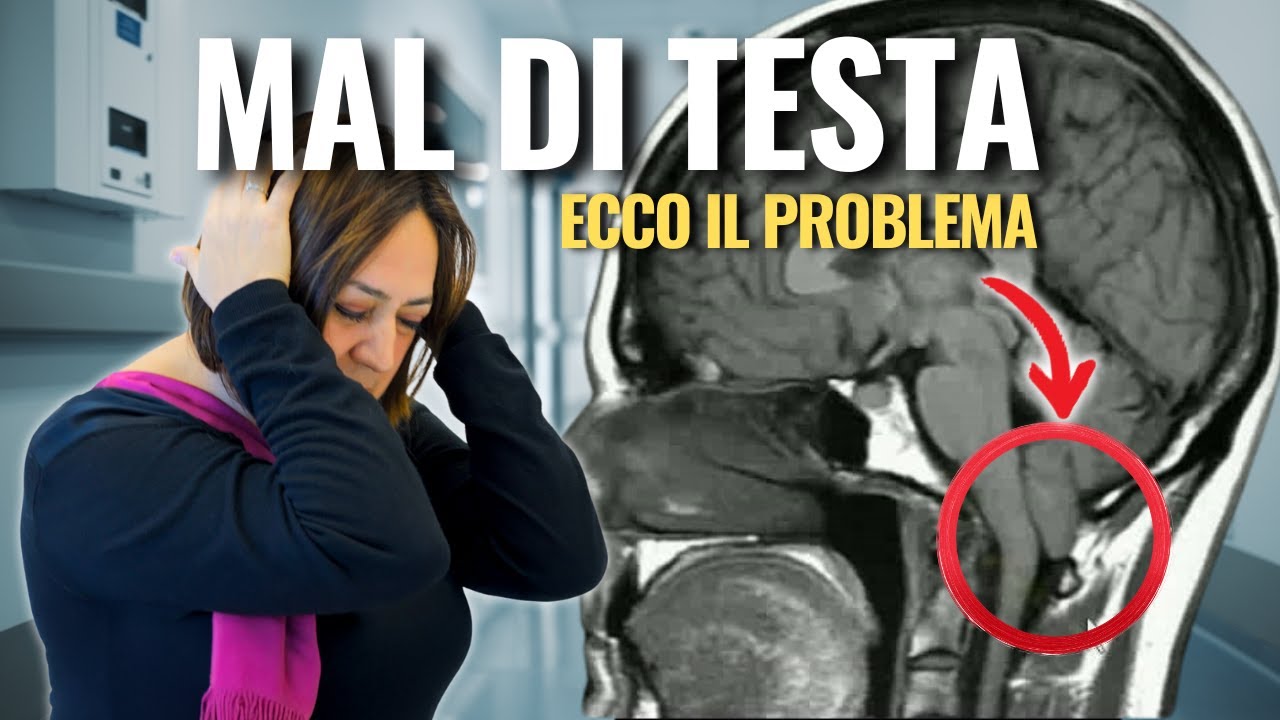 Sindrome di Chiari: Mal di Testa Insopportabile, Diagnosi e Intervento
