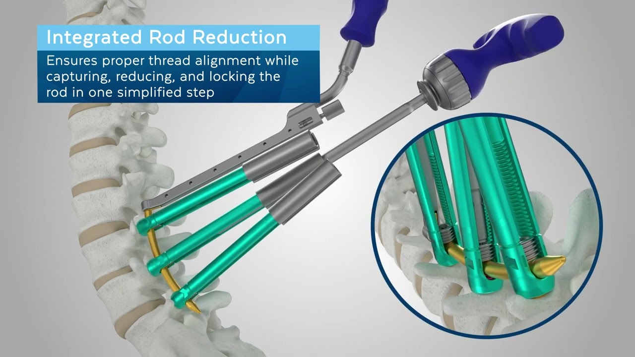 CREO MIS® Minimally Invasive Posterior Stabilization System (Japan Only)