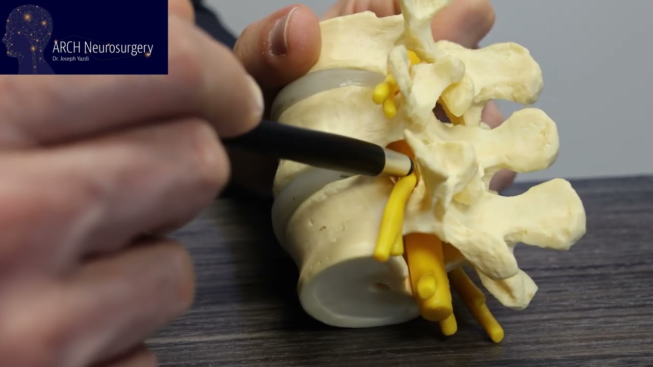 Lumbar Discectomy