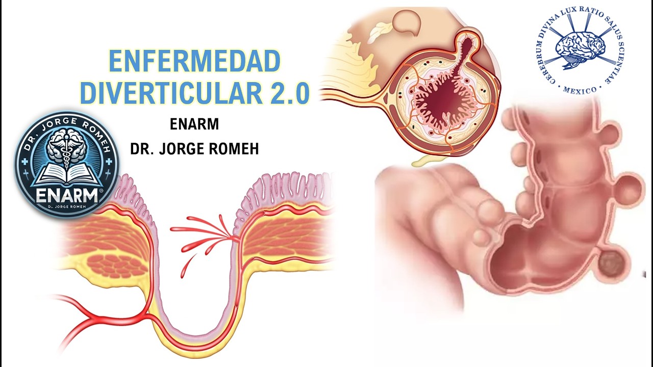 ENF  DIVERTICULAR 2.0 - ENARM - TODO LO QUE DEBES SABER