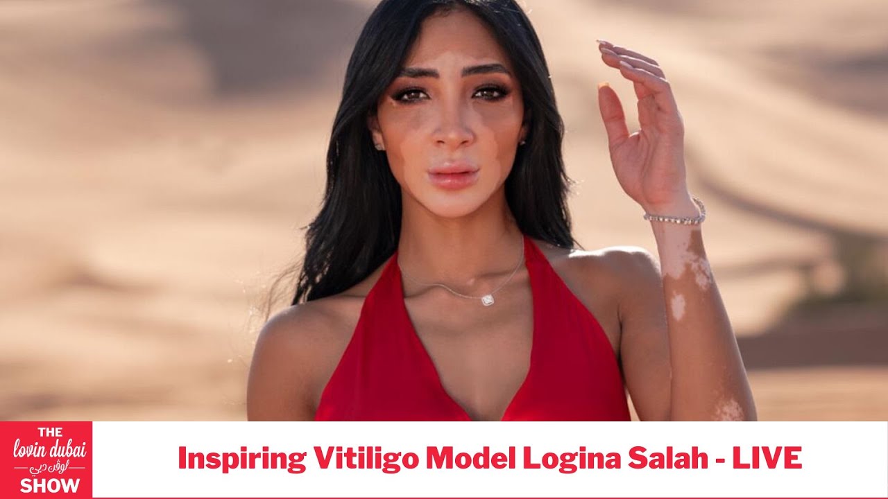 Inspiring Vitiligo Model Logina Salah LIVE With Lovin Dubai