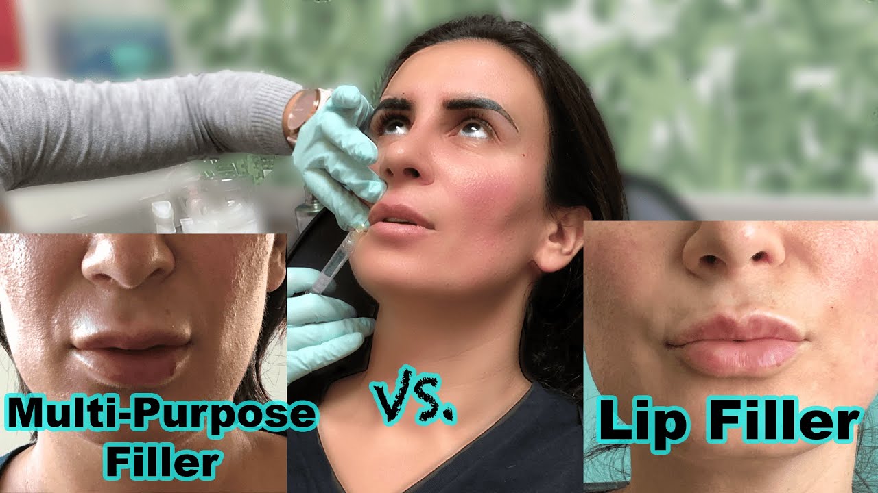 Lip Fillers $450 Compared to $700 || Restylane/Juvederm Versus Restylane Kysse