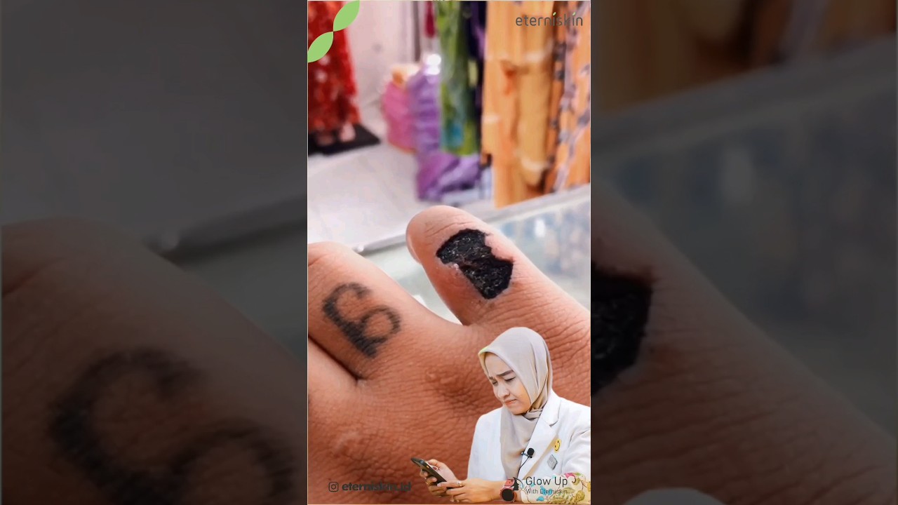 Serbuk PK Buat Hapus Tatto ?? Emang Bisa ?? #shorts #eterniskin #klinikkecantikan #tattoremoval