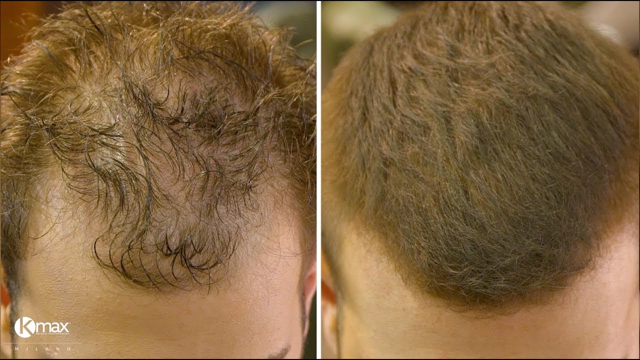 How to cut & disguise thinning hair with Kmax Products | Yiannis Sakellarakis