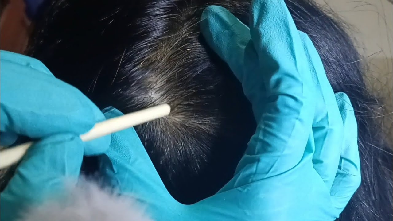 ASMR: Dandruff Scratching