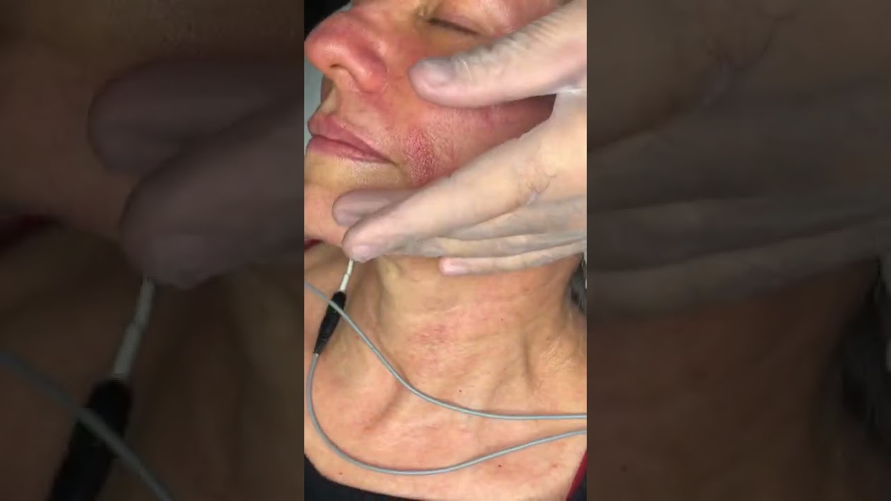 (Parte 1) Jato de Plasma na linha de código de barras ou região perioral