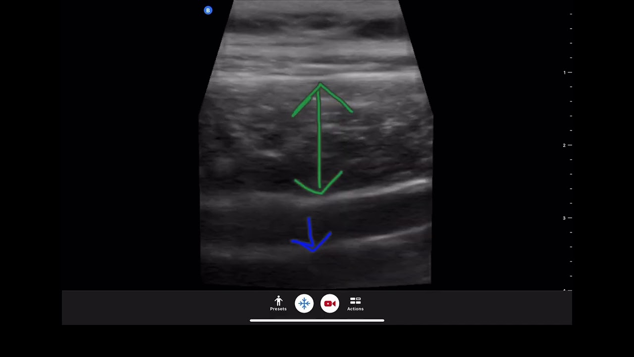 Using Ultrasound Imaging to teach Transverse Abdominis Contraction to Help Treat Bladder Issues.