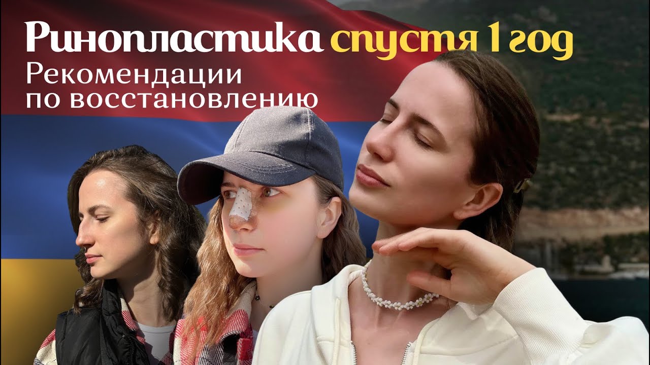 Ринопластика спустя 1 год | Рекомендации по восстановлению