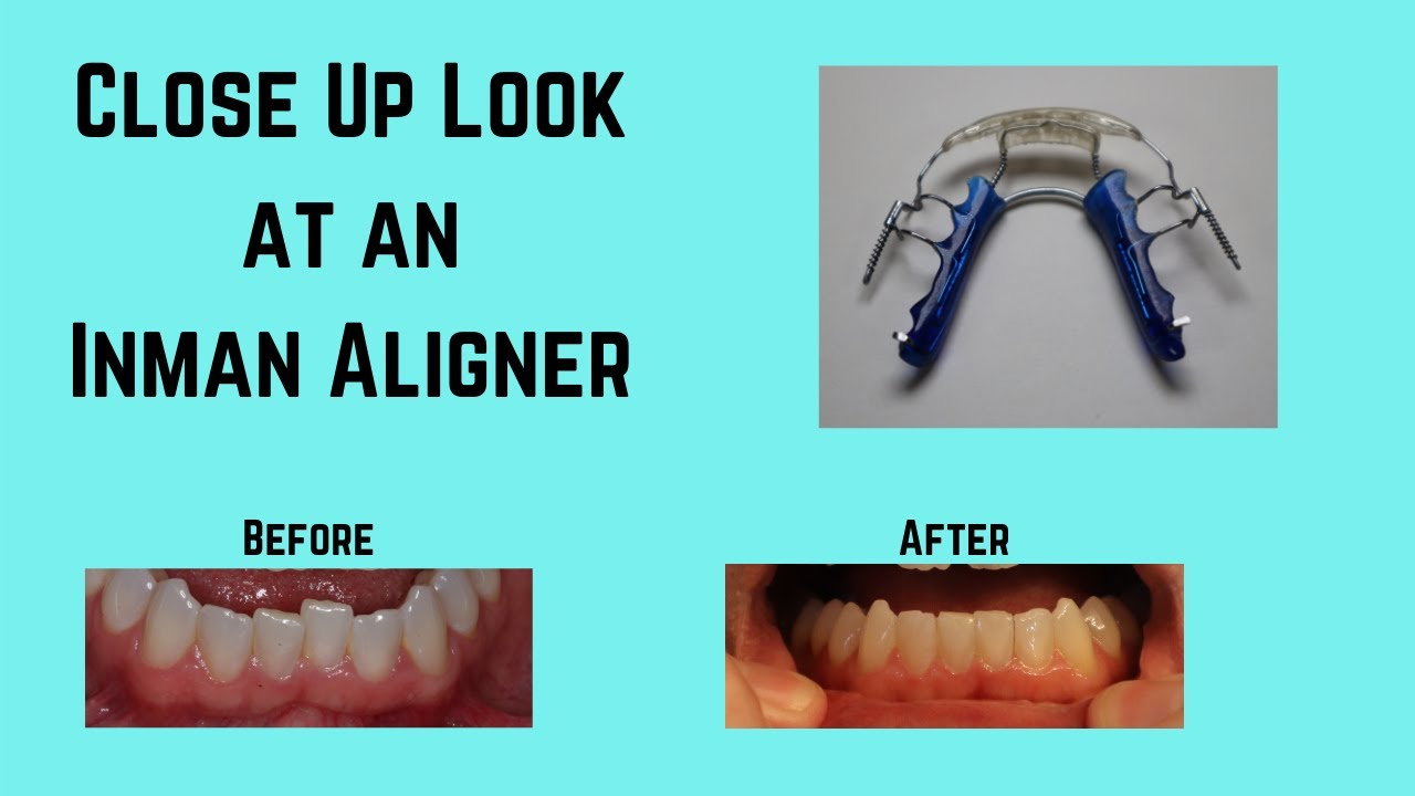 What is an Inman Aligner