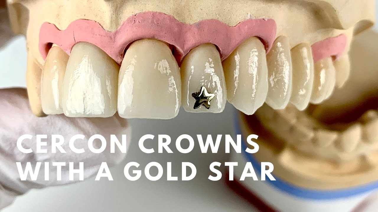 Cercon Crowns With A Gold Star