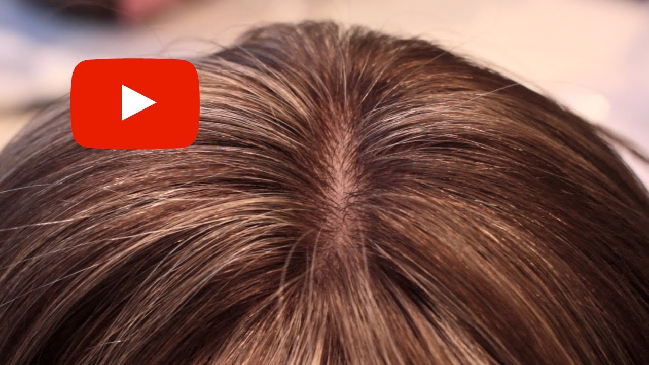 Découvrez la micro-greffe capillaire sans chirurgie !