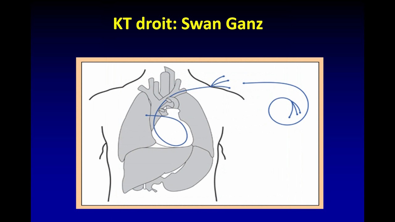 hypertension artérielle pulmonaire : new guidelines 2015