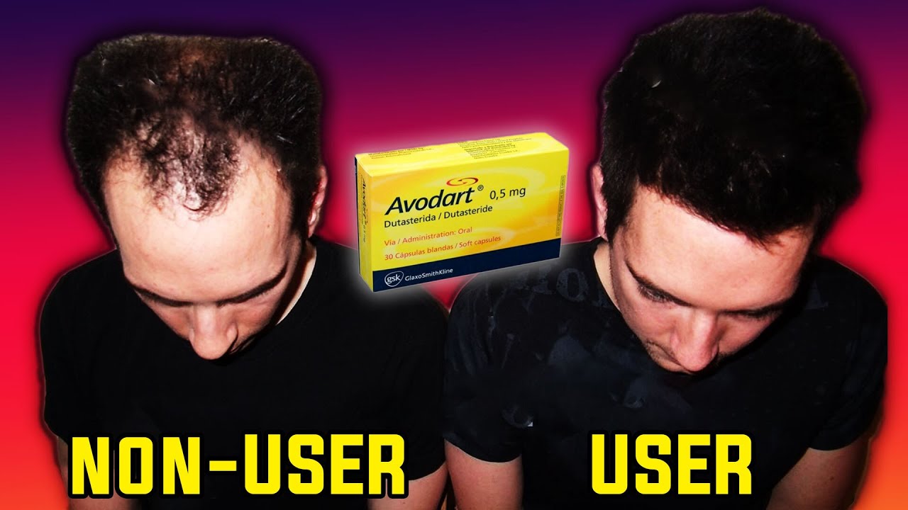 One Twin Used Dutasteride And The Other Didn't... Guess What Happened Next