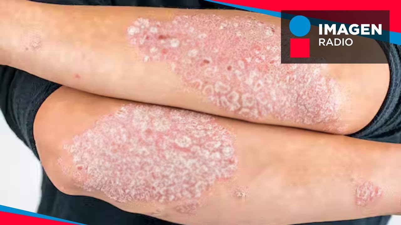 ¿Qué es y qué causa la Psoriasis?