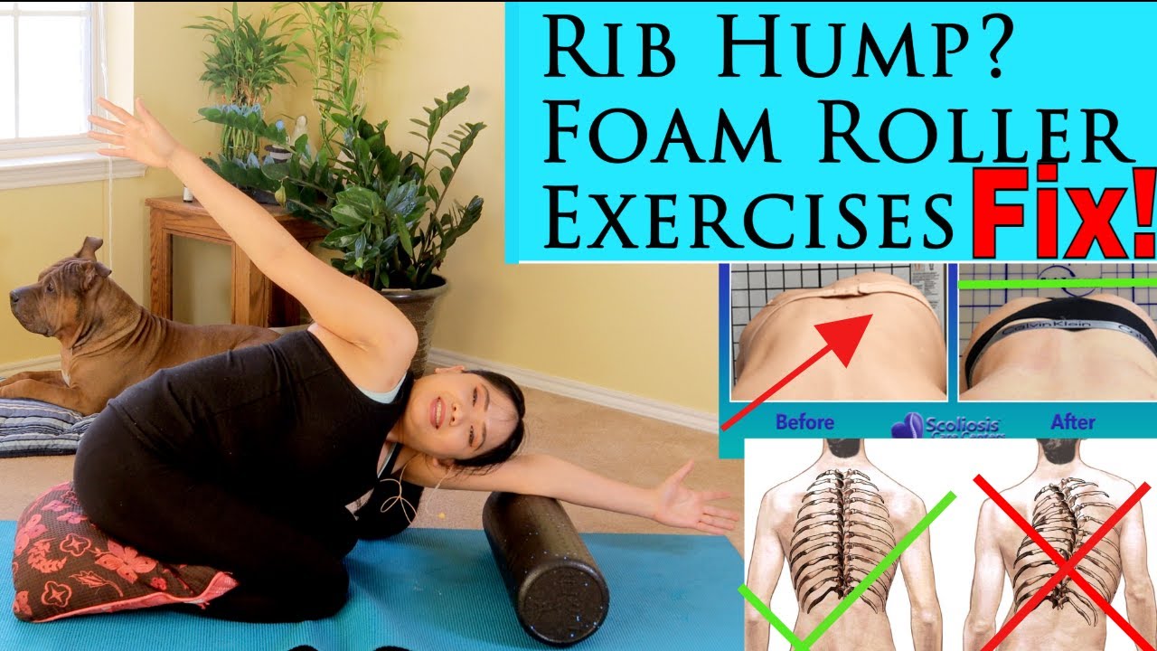 Реберный горб из-за сколиоза? Йога с пенным валиком поможет!