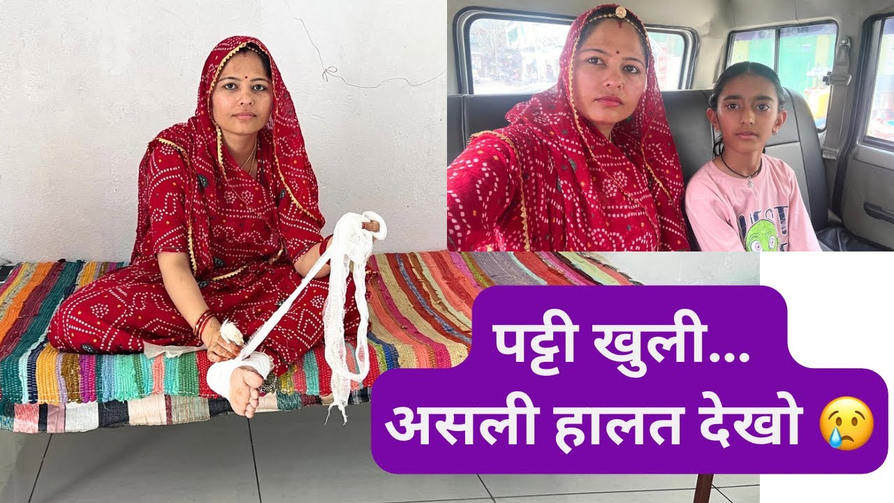 कॉर्न ऑपरेशन के बाद पहली बार पट्टी खोली | पैर में इतने टांके 😢