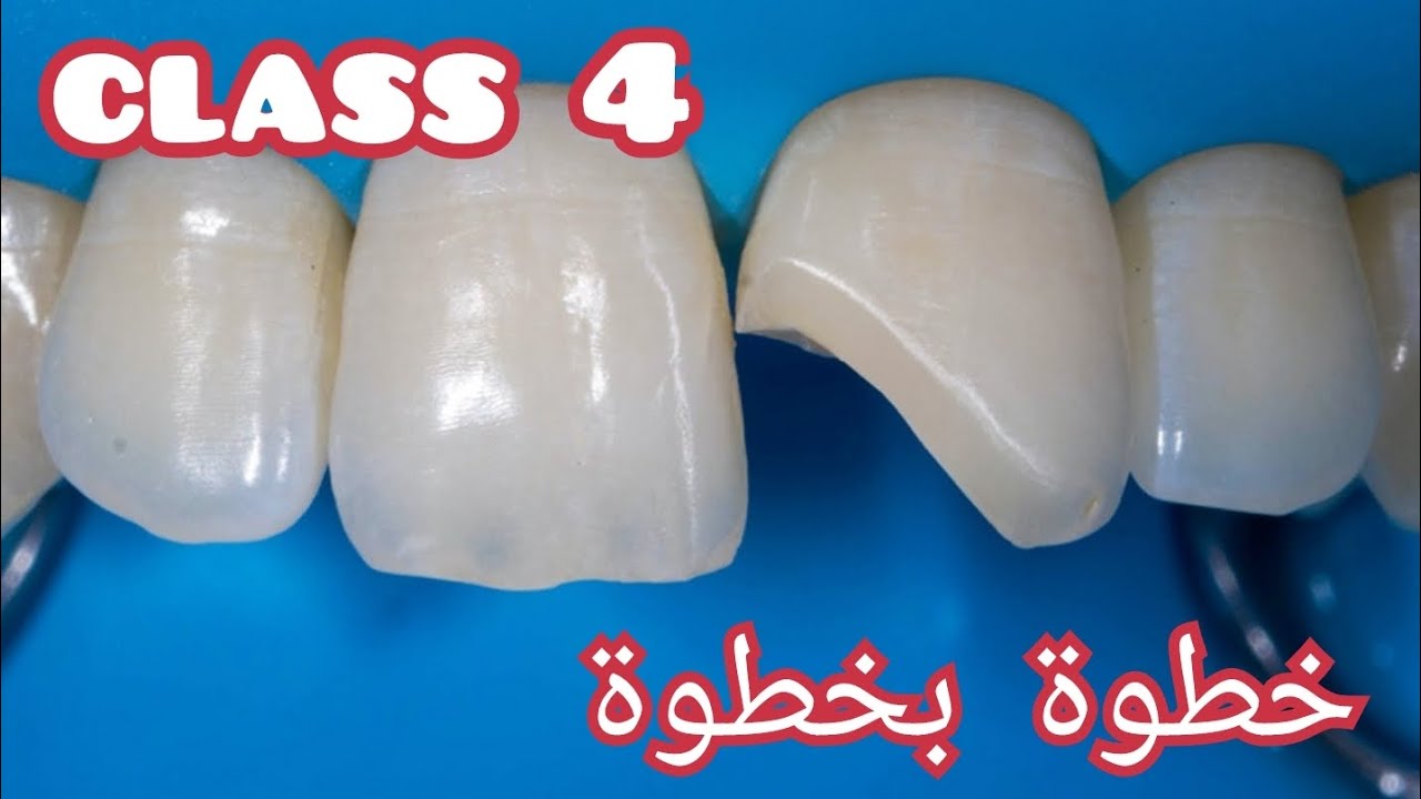 حشوة كومبزت كلاس ٤ composite restoration cl.4