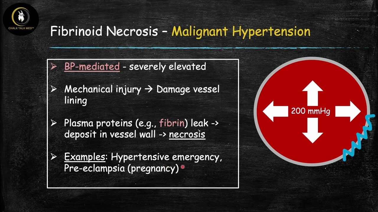Necrosis 4 (Fibrinoid)