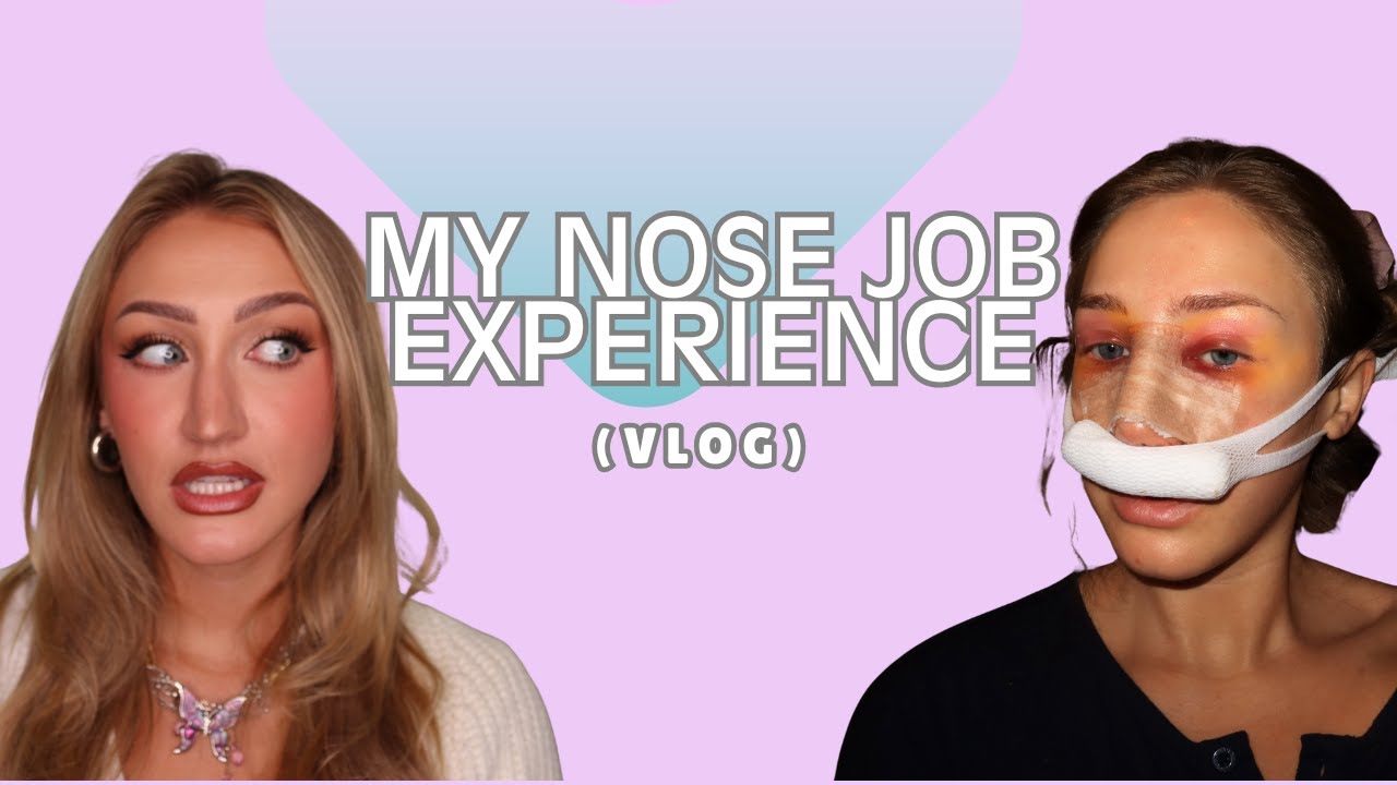 The Reality of a Nose Job: My Septorhinoplasty Experience