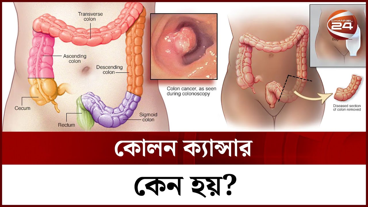 কোলন ক্যান্সার কেন হয়? | Colon Cancer | Channel 24