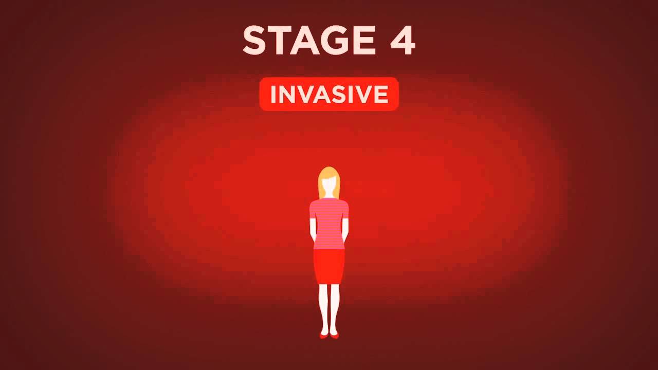 Beyond The Shock - Chapter 5 -  Types & Stages - Stage 4 Breast Cancer