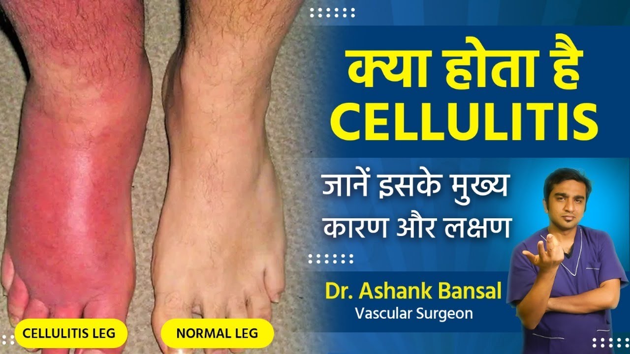 What is Cellulitis? Understanding Causes, Symptoms, and Treatment Options with Dr. Ashank Bansal