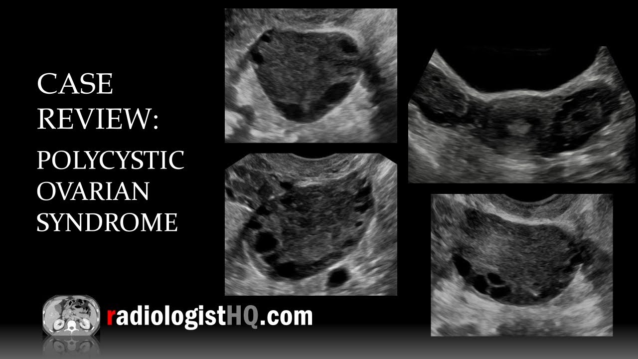 Ultrasound of Polycystic Ovarian Syndrome