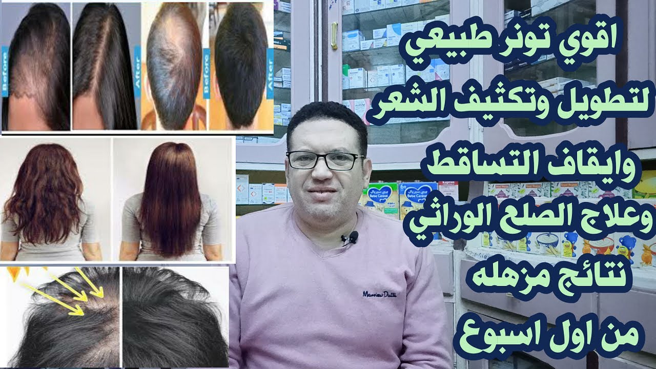 اقوي تونر طبيعي لتطويل وتكثيف الشعر وايقاف التشاقط وعلاج الصلع الوراثي وملئ فراغات فروة الراس