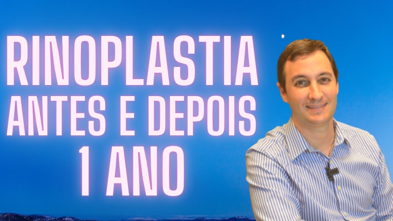 Rinoplastia antes e depois de 1 ano
