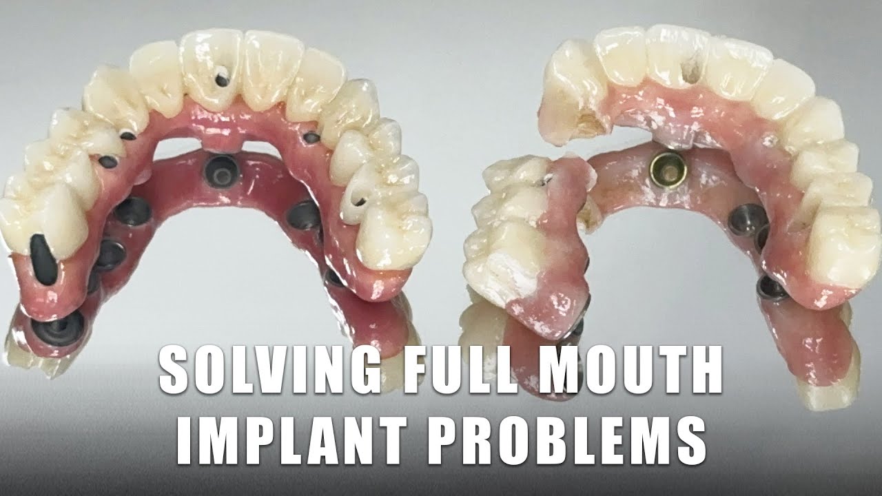 Solving Full Mouth Implant Problems