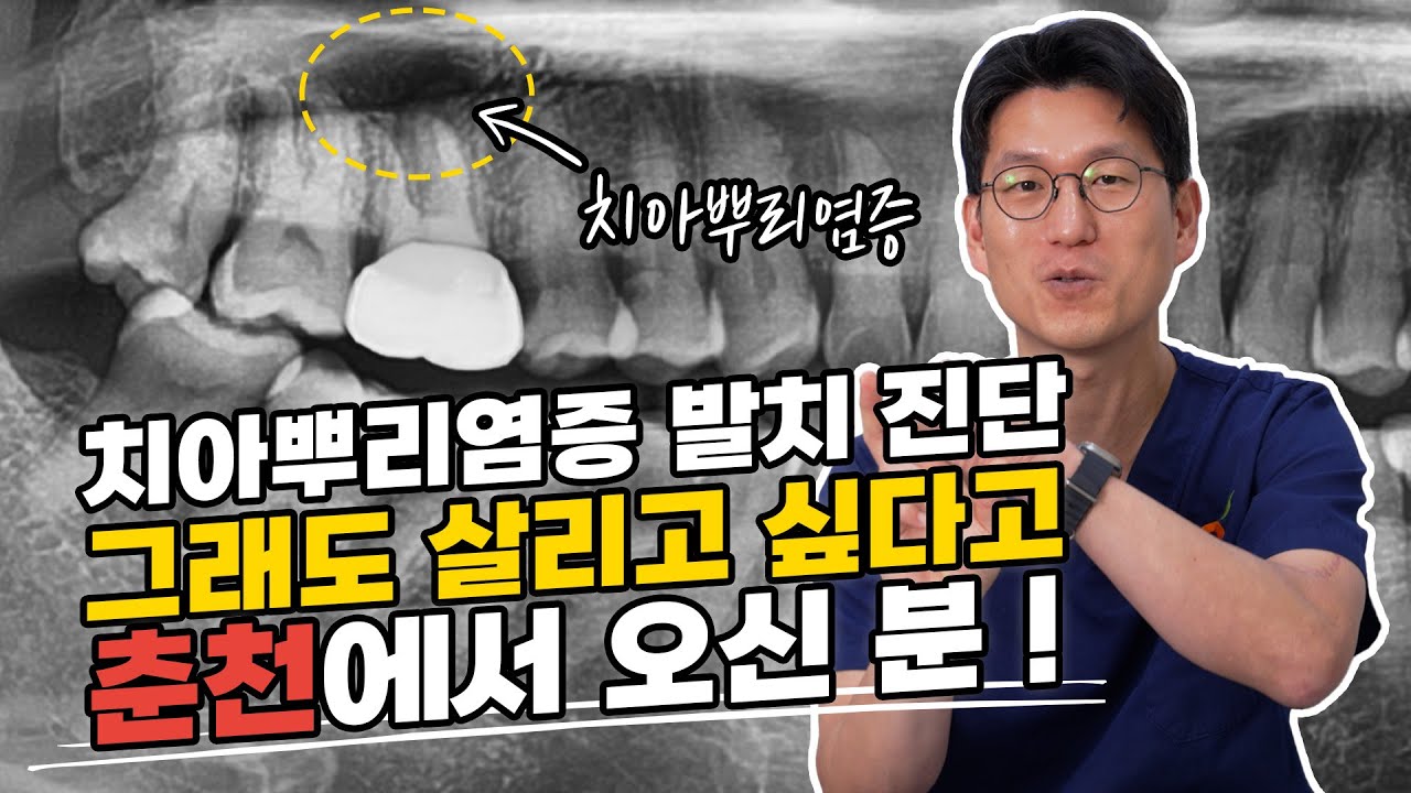크라운 씌우고 재발한 치아뿌리염증! 발치 안 하고 신경치료+치근단절제술로 살렸습니다 👍
