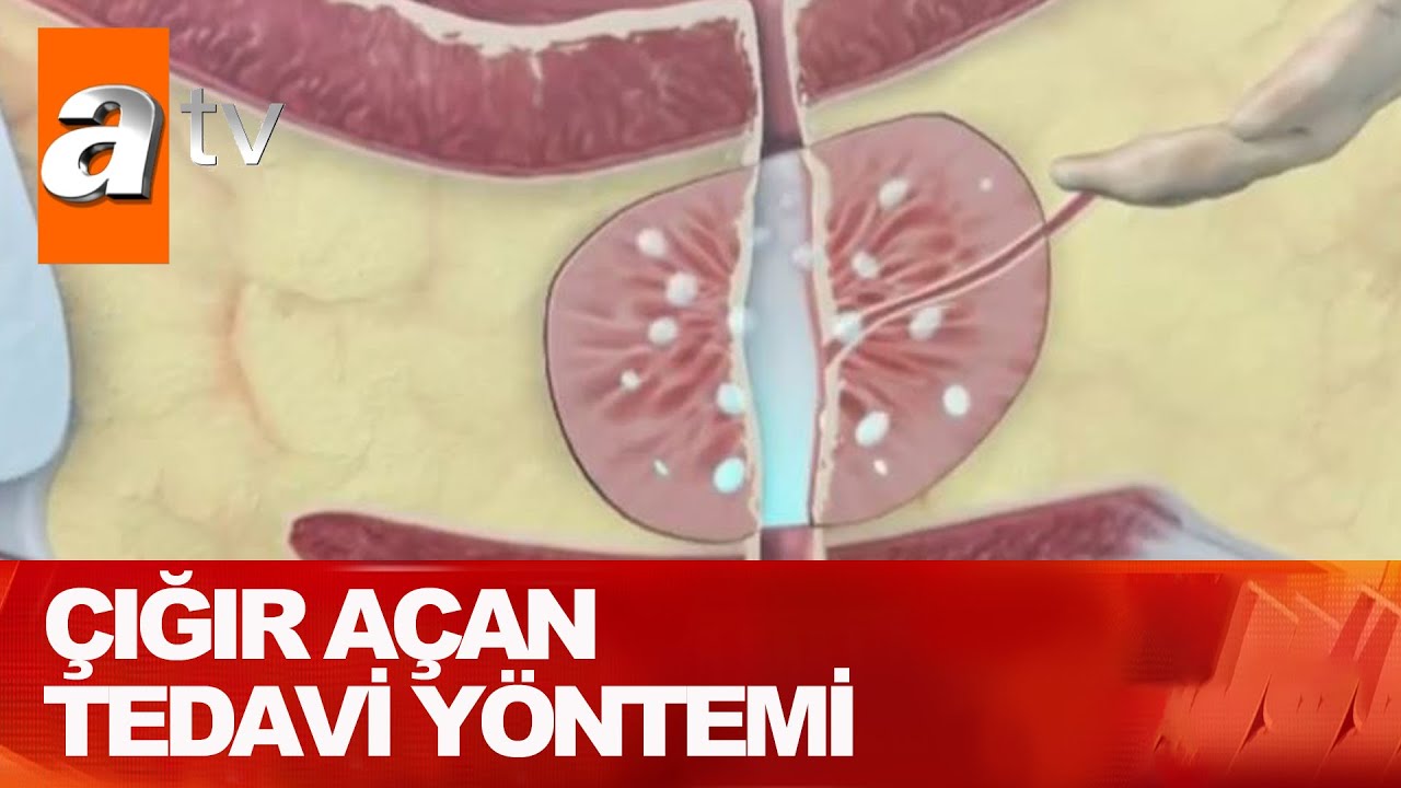 Prostatta ameliyat kabusu bitiyor - Atv Haber 22 Temmuz 2021