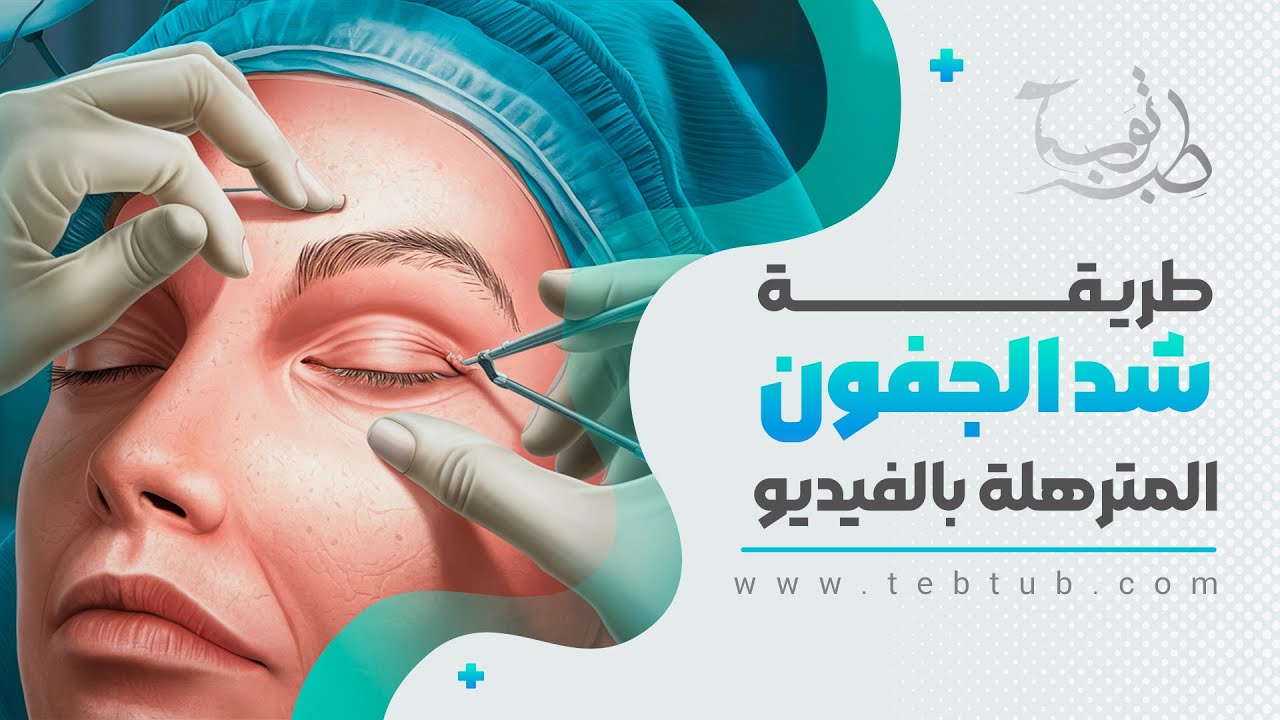 شاهد طريقة شد الجفون المترهلة بالفيديو - ازالة الدهون من الجفن السفلي والعلوية - طب توب