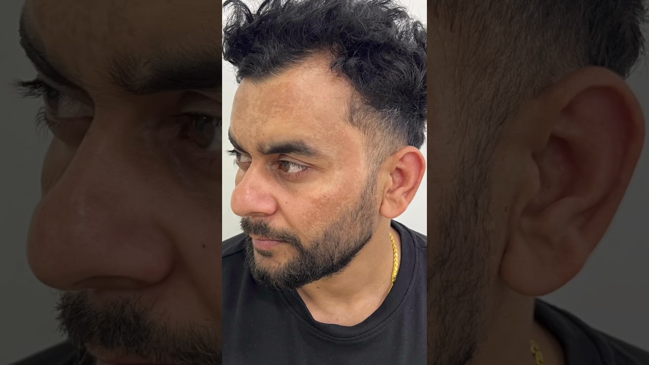 Best Pigmentation Result| Melasma Treatment | Crystal Skin Treatment | MedRootz Clinics 