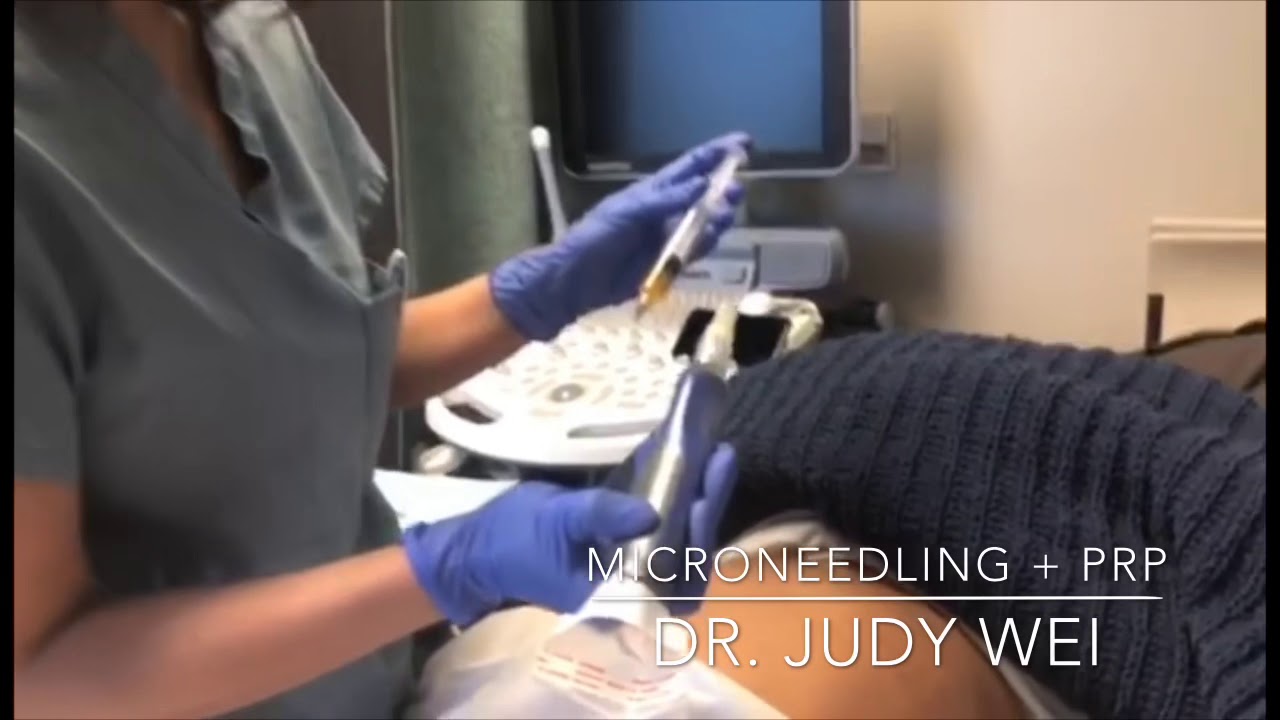 Microneedling with PRP for stretch marks