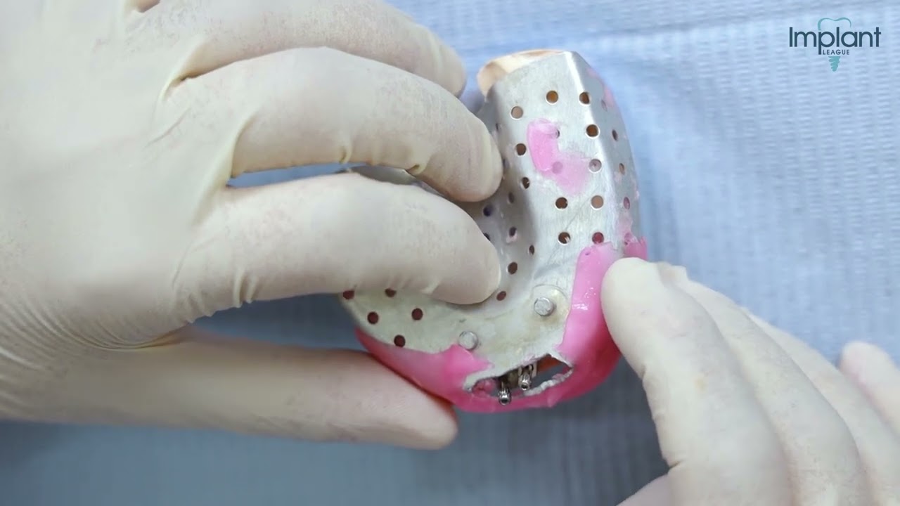 open tray impression for implant مقاسات زراعة الأسنان