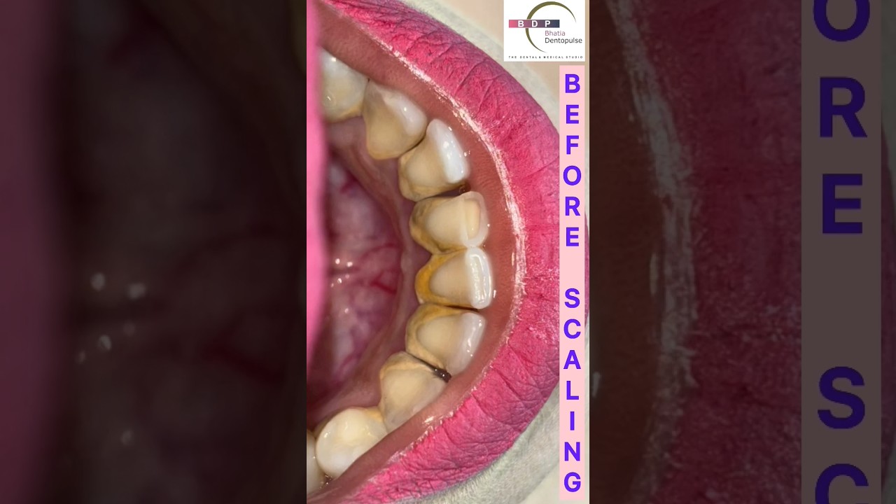 Teeth Cleaning by Doctor #scaling #teethcleaning #dentist