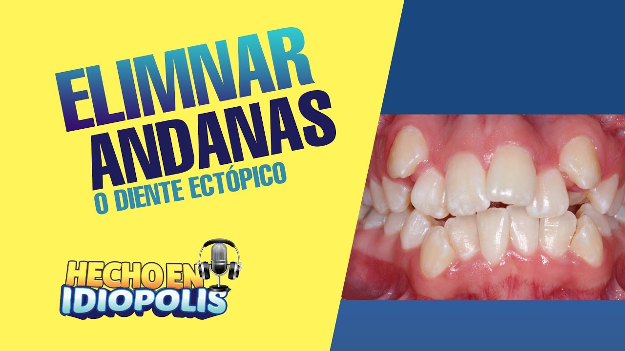 Como Eliminar Andanas o diente ectópico Odontología Para Idiopolis