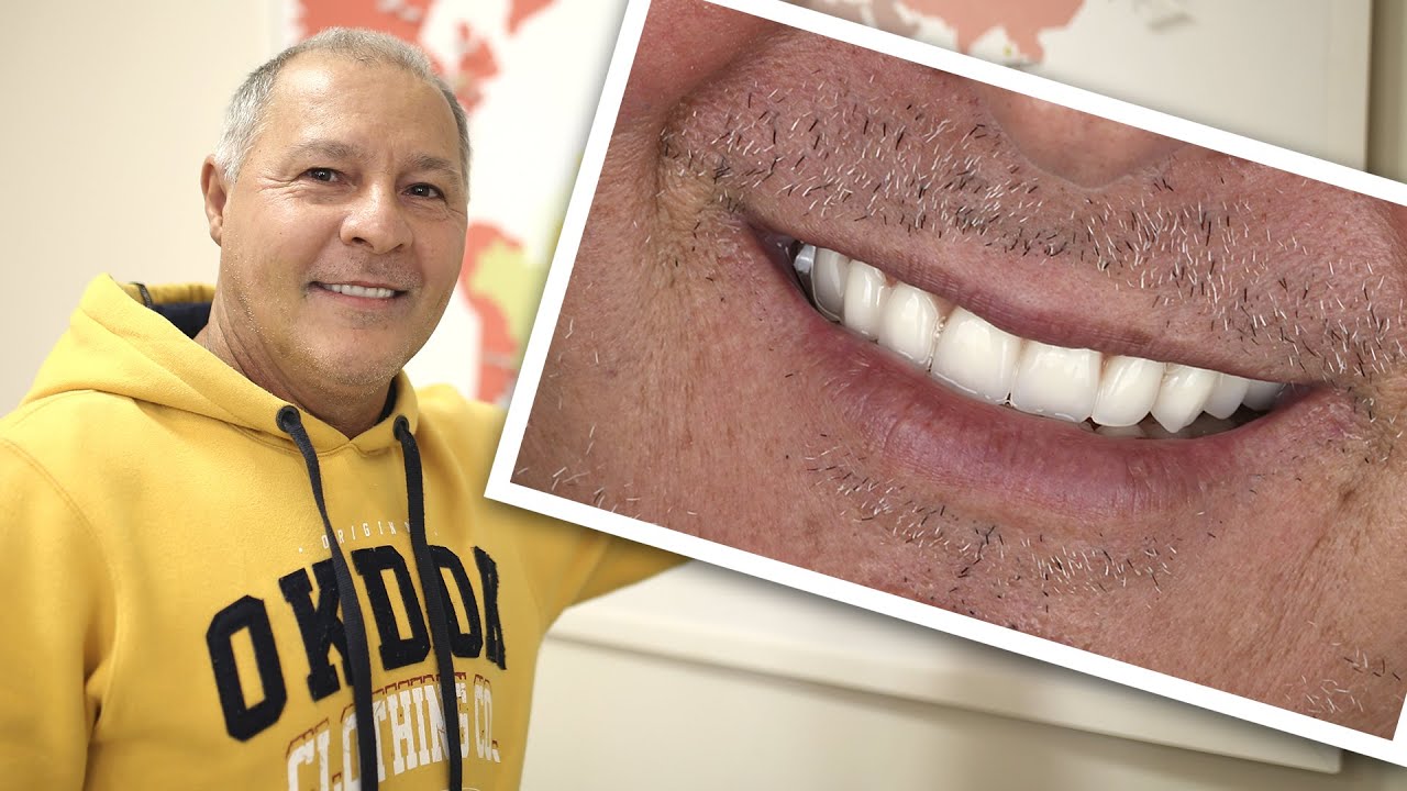 Implantes Dentários Arcada Completa - Depoimento Implace Implantes