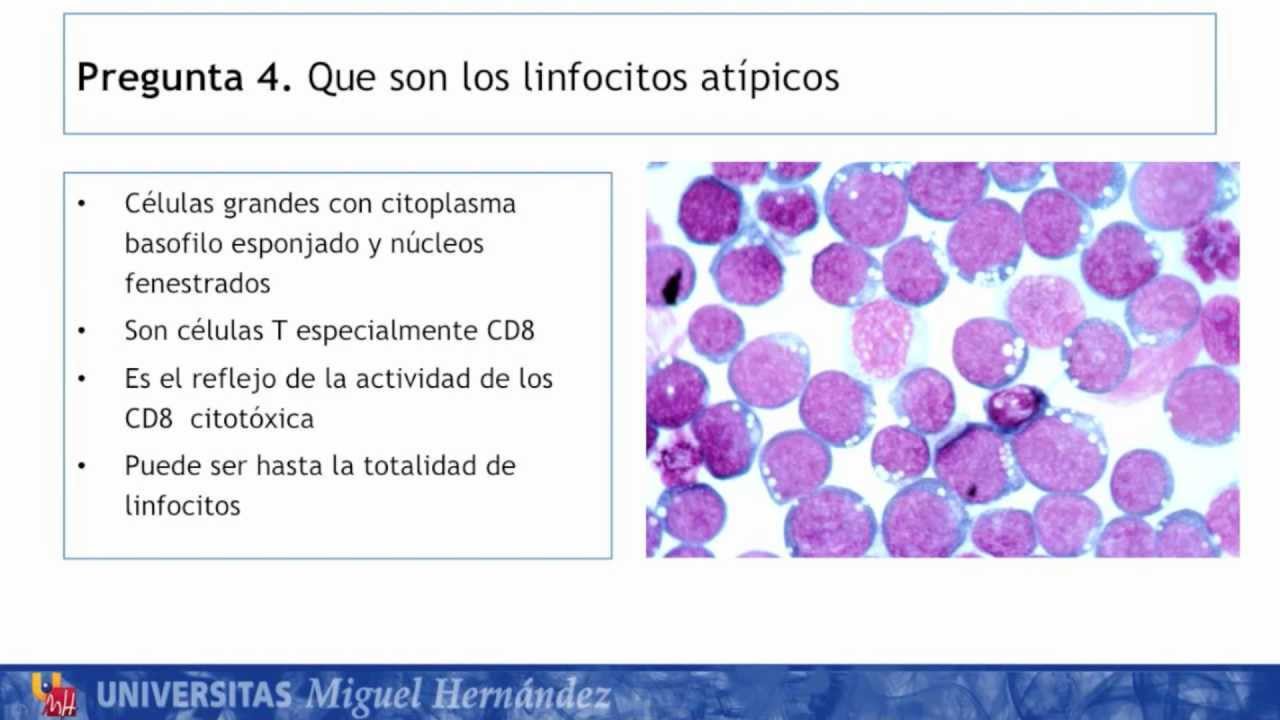 umh1947 2012-13 Caso005 Enfermedades de base inmune Mujer de 15 a&ntilde;os con fiebre