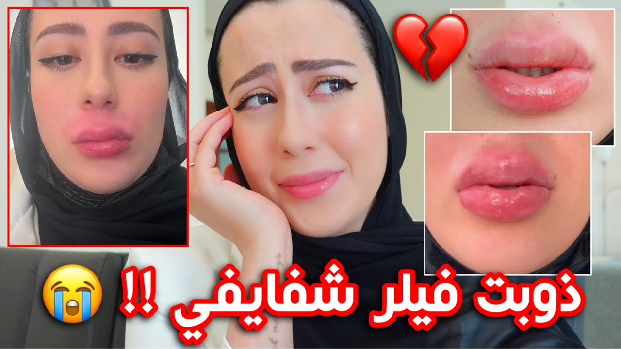 و اخيرا ذوبت الفيلر اللي موجود بشفايفي !! 😭 شوفوا شو صارلي 💔 || شهد ناصر 🌸