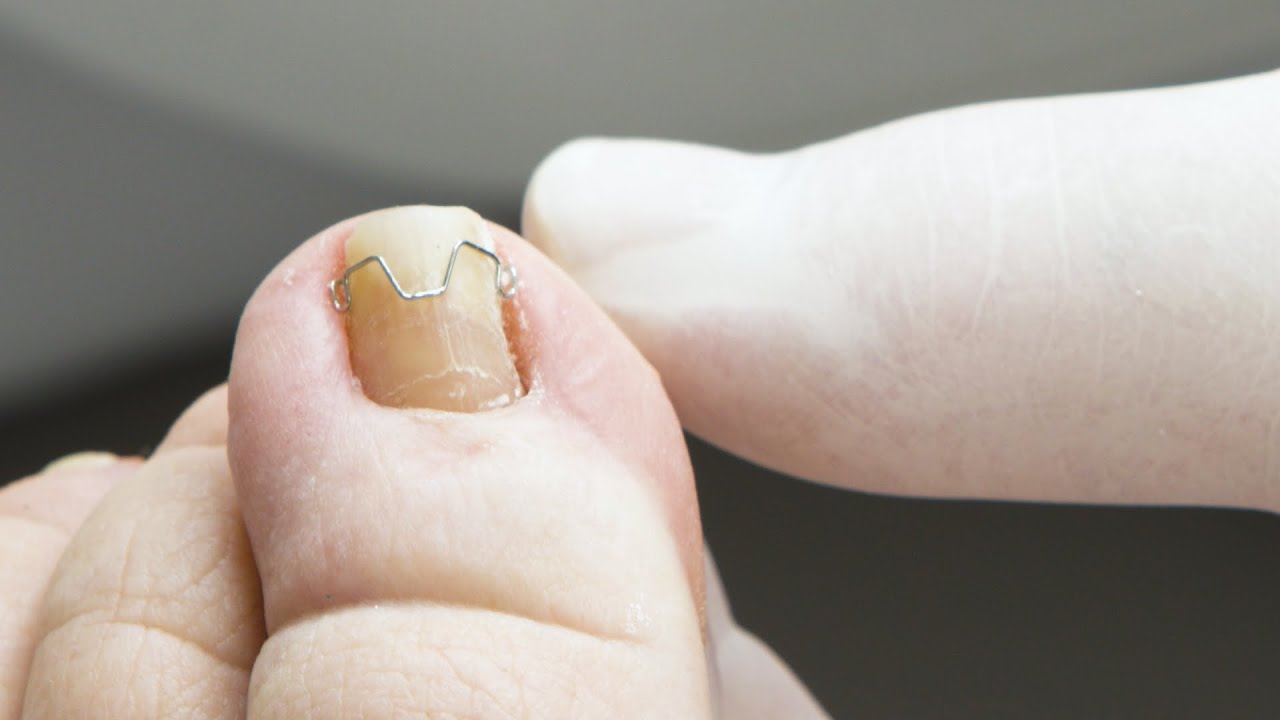 TOPSIDECLIP Nagelkorrektur-Spange: Anwendung