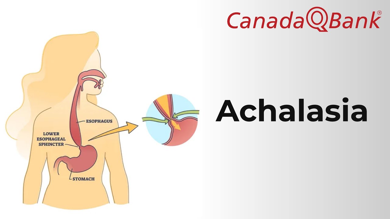 Achalasia Explained | Dysphagia, Diagnosis & Management | CanadaQBank